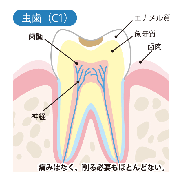 新琴似（札幌市北区）の歯医者、ふれあいの杜歯科・こども歯科のむし歯治療