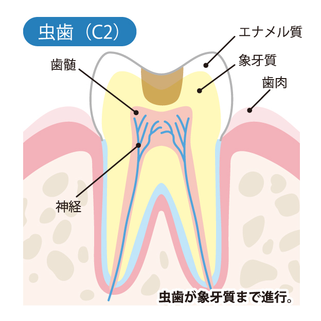 新琴似（札幌市北区）の歯医者、ふれあいの杜歯科・こども歯科のむし歯治療