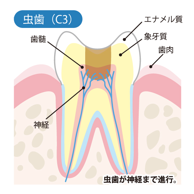 新琴似（札幌市北区）の歯医者、ふれあいの杜歯科・こども歯科のむし歯治療