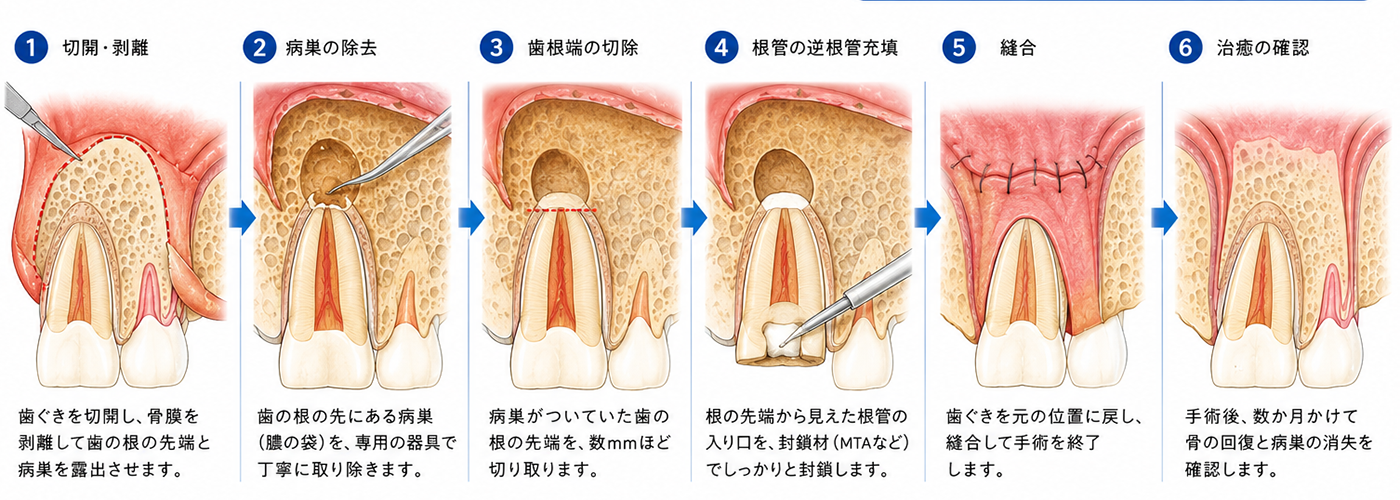 新琴似（札幌市北区）の歯医者、ふれあいの杜歯科・こども歯科の精密根管治療