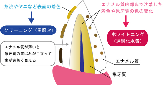 新琴似(札幌市北区)の歯医者、ふれあいの杜歯科・こども歯科のホワイトニング